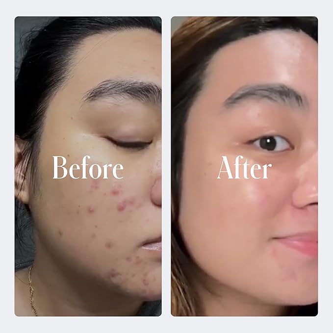 Geologie Clear System | 3-Step Acne