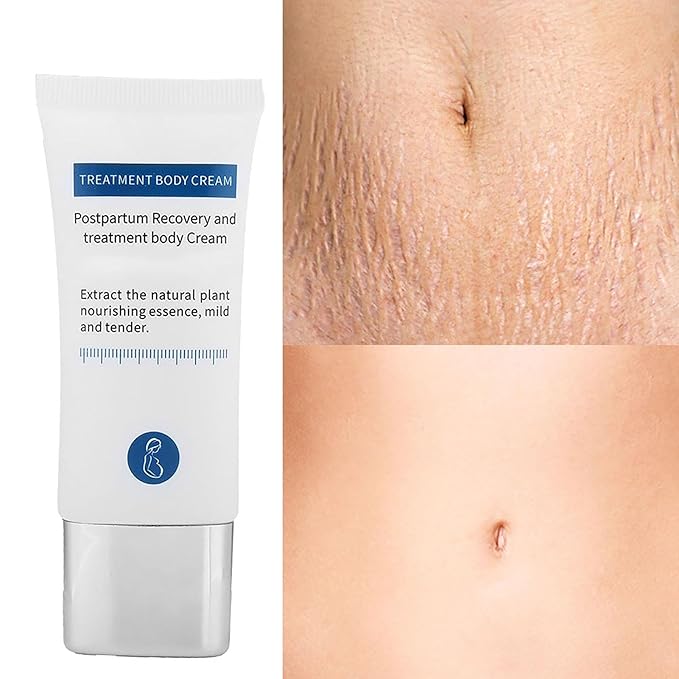 Generic Stretch Marks Removal Cream, Reduce