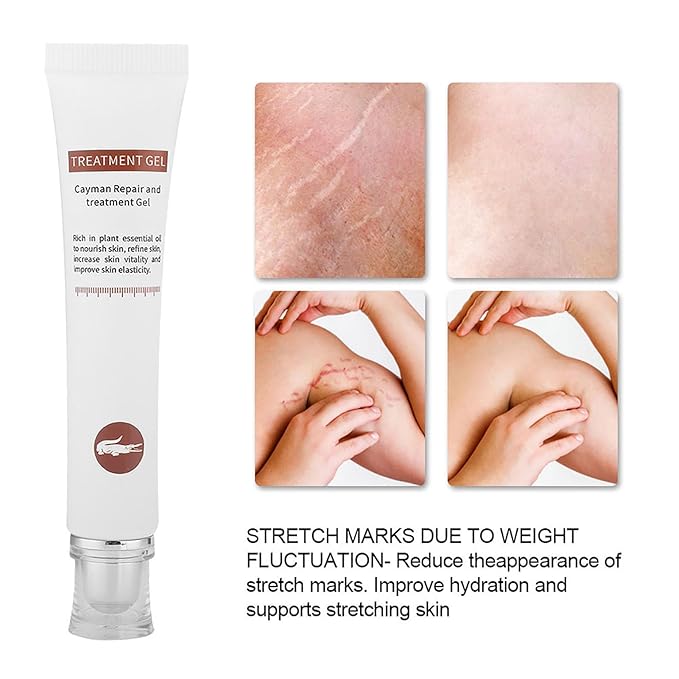 Generic Stretch Marks Removal Cream, Reduce