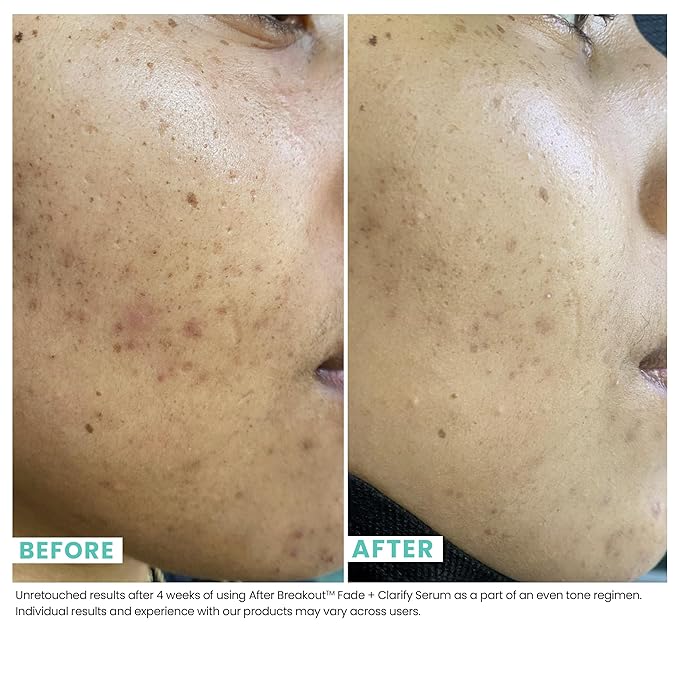 Urban Skin Rx, Acne & Dark Cleansing