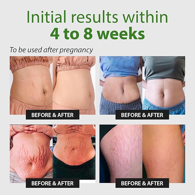 Abera Ovela Stretch Mark Cream, Stretch